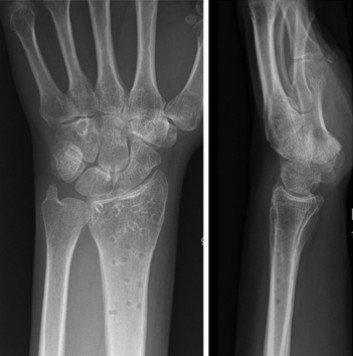 Distal Radius Fractures-14