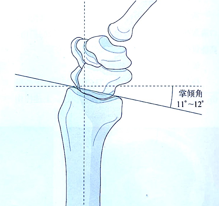 Distal Radius Fractures-2