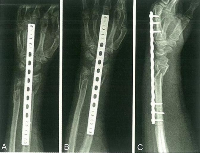 Distal Radius Fractures-21