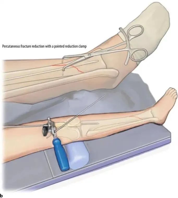 ការបាក់ឆ្អឹង Tibial, Suprapatellar Litrimullary Tearique-15