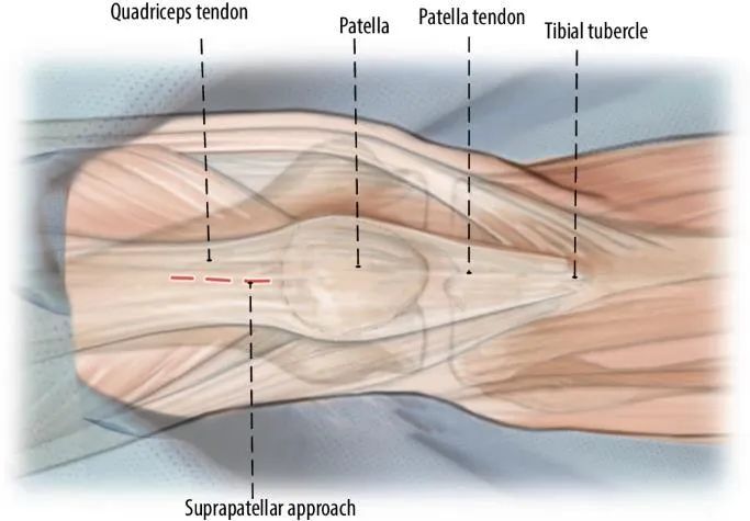 ការបាក់ឆ្អឹង Tibial, Suprapatellar Litrimullary Tearique-5