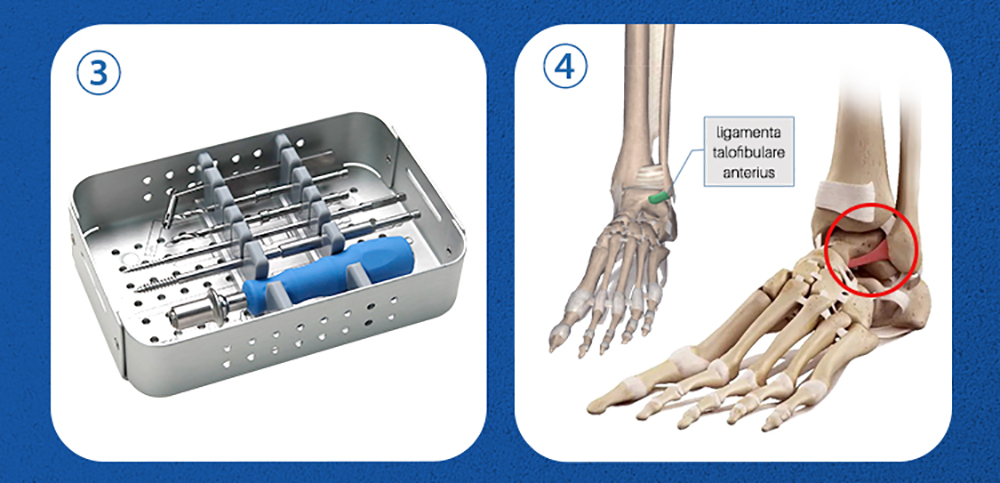 Ligamenta Talofibulare Anterius Reconstruction Instrument Set - XC Medico