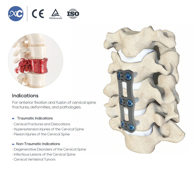 Anterior Cervical Plate System | Titanium Spine Implant | XC Medico
