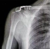 Dijanjosi u Trattament ta 'Frattura ta' Clavicle-26