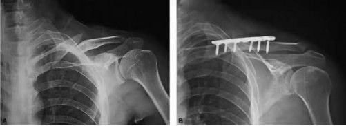Dijanjosi u Trattament ta 'Frattura ta' Clavicle-17