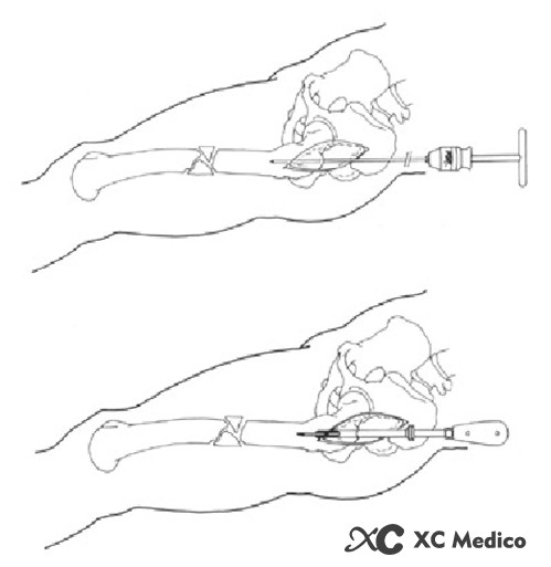 5 intramedullary nail application principles and surgical techniques-12