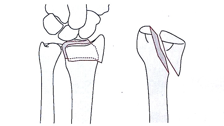 Distal Radius Fractures-4