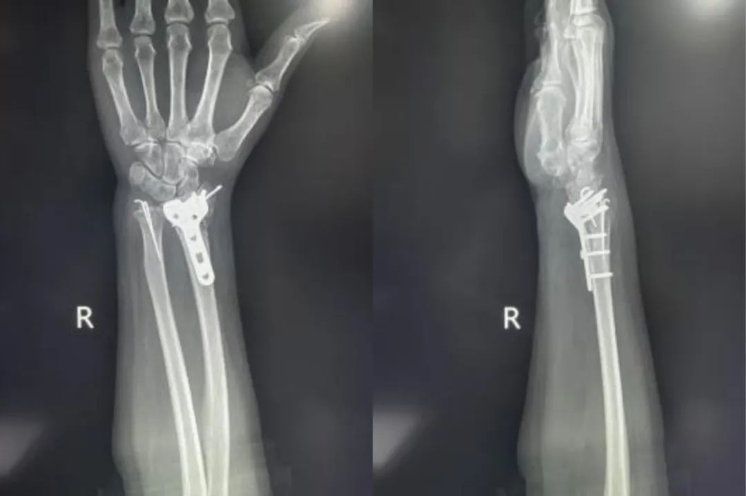 Distal Radius Fractures-20
