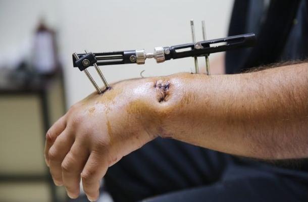 External fixation banner-2