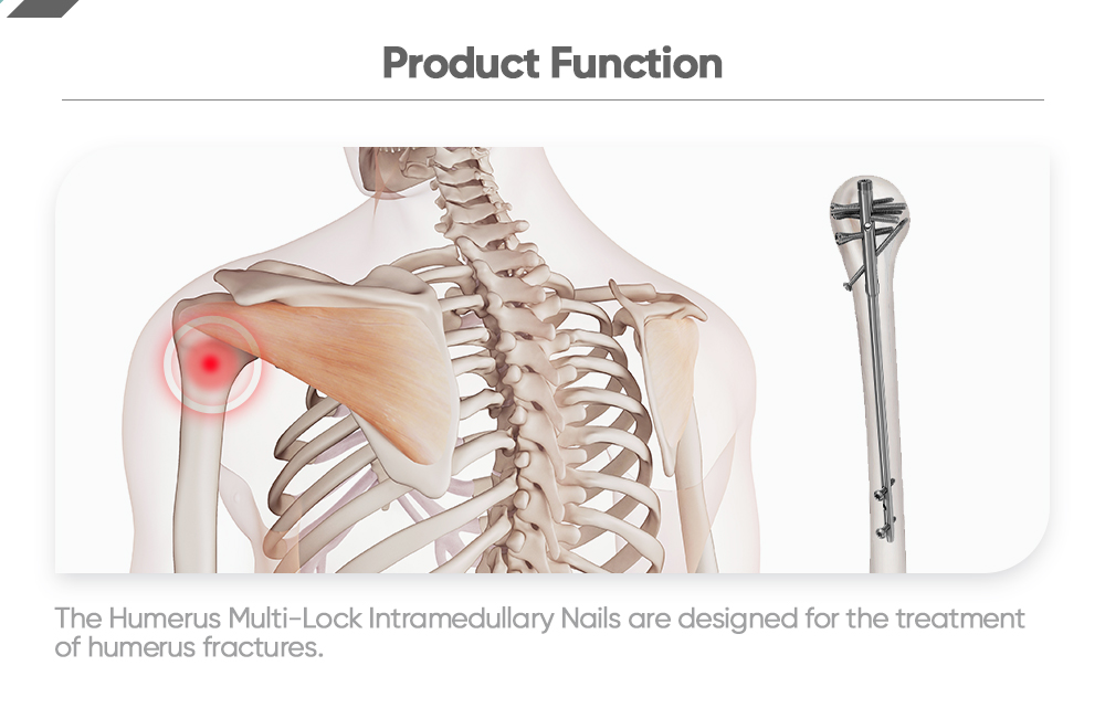 Humerus Multi-Lock Intramedullary Nail - Buy Product on XC Medico
