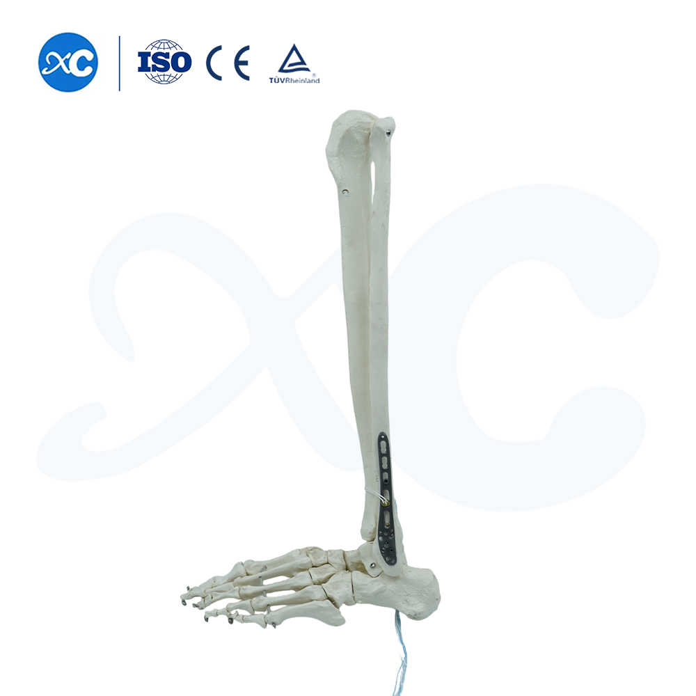 Distal Tibiofibular Locking Plate-III - Buy Product on XC Medico