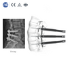 MisFix 5.5 System | Minimally Invasive Pedicle Screw | XC Medico