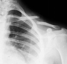Dijanjosi u Trattament ta 'Frattura ta' Clavicle-3