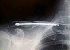 Dijanjosi u Trattament ta 'Frattura ta' Clavicle-21