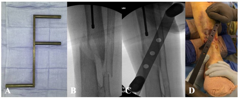 បច្ចេកទេសជួសជុលក្រចក Tibial Tibial intripullary-5