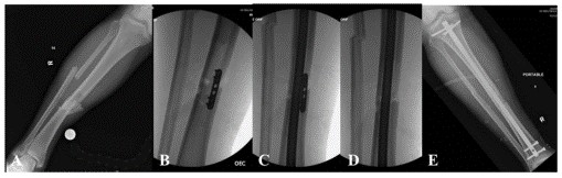 Tibial Intramedullary Nail Fixation Technique