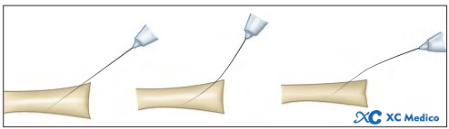 Classic methods and techniques of closed needle insertion for distal radius fractures