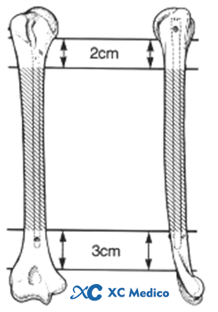 5 intramedullary nail application principles and surgical techniques-1