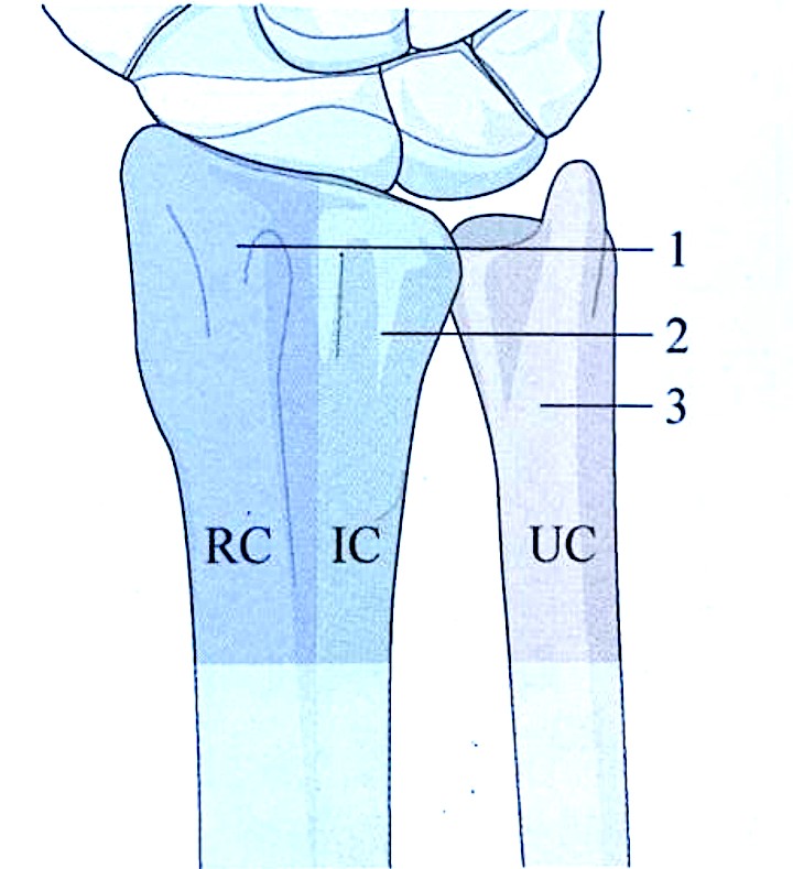 Distal Radius Fractures