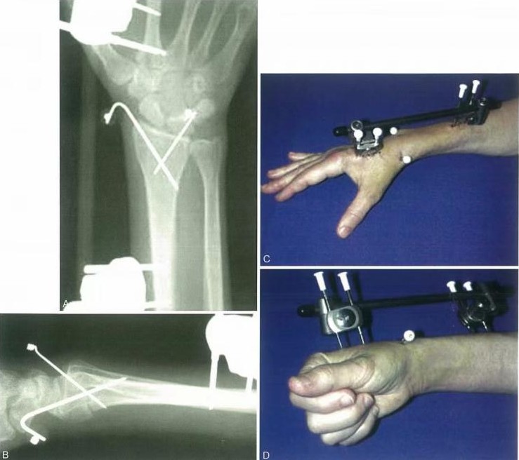 Distal Radius Fractures-11