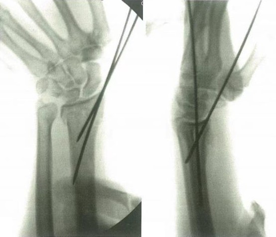 Distal Radius Fractures-9