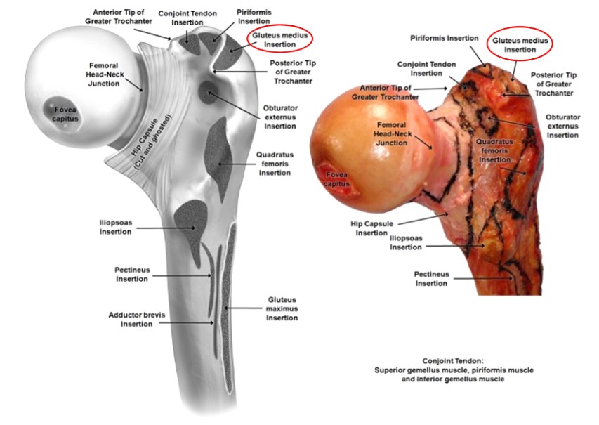 Femoral Intramedullary Nailing - How To Choose The Best Insertion Point-2