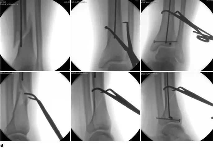 ការបាក់ឆ្អឹង Tibial, Suprapatellar intripalullary បច្ចេកទេសក្រចក -1 14