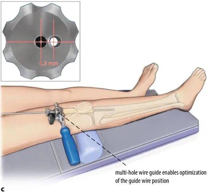 ការបាក់ឆ្អឹង Tibial, Tranapatellar Litrimalullary Tearique-9