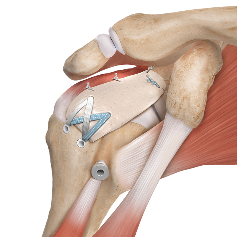 Rotator cuff tear