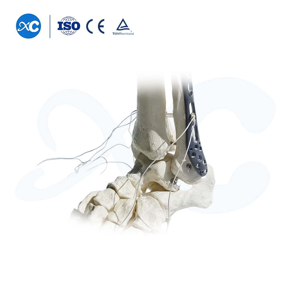Distal Tibiofibular Locking Plate-III - Buy Product on XC Medico