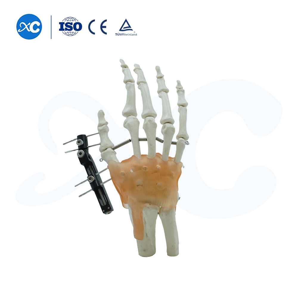 External Fixation for Metacarpals And Phalanges - Buy Product on XC Medico