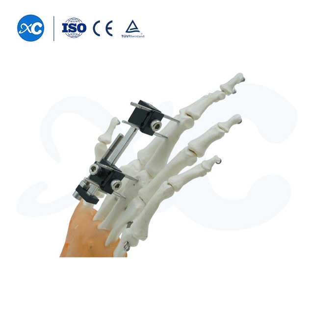 External Fixation for Metacarpals And Phalanges - Buy Product on XC Medico