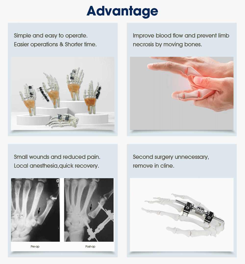 External Fixation Of Metacarpals And Phalanges - Image 5