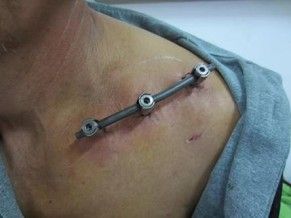 Dijanjosi u Trattament ta 'Frattura ta' Clavicle-29