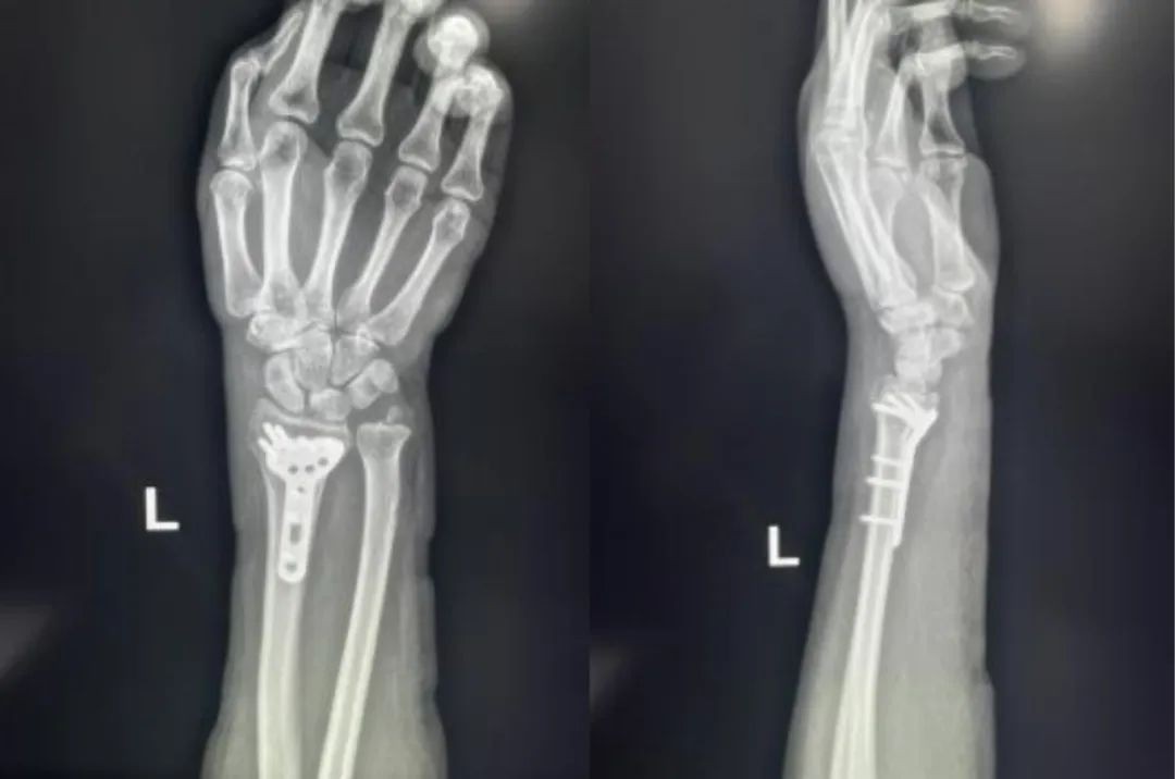 Distal Radius Fractures-18