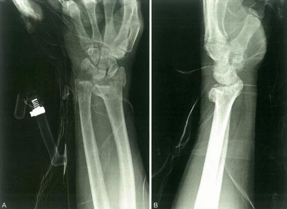 Distal Radius Fractures-22
