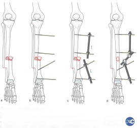 External Fixator