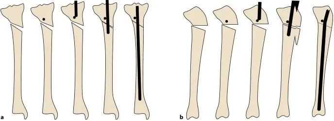 ការបាក់ឆ្អឹង Tibial, Suprapatellar Litrimallary Tearique-20