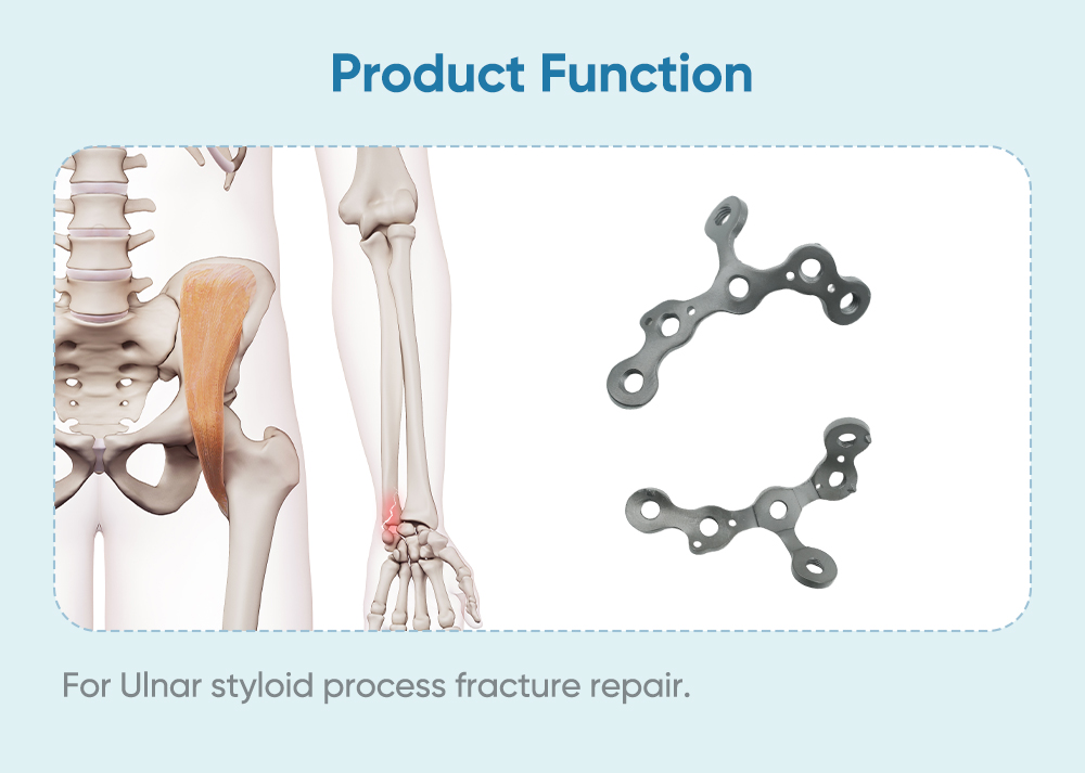 Locking Plate for Ulnar Styloid Process II - Buy Product on XC Medico