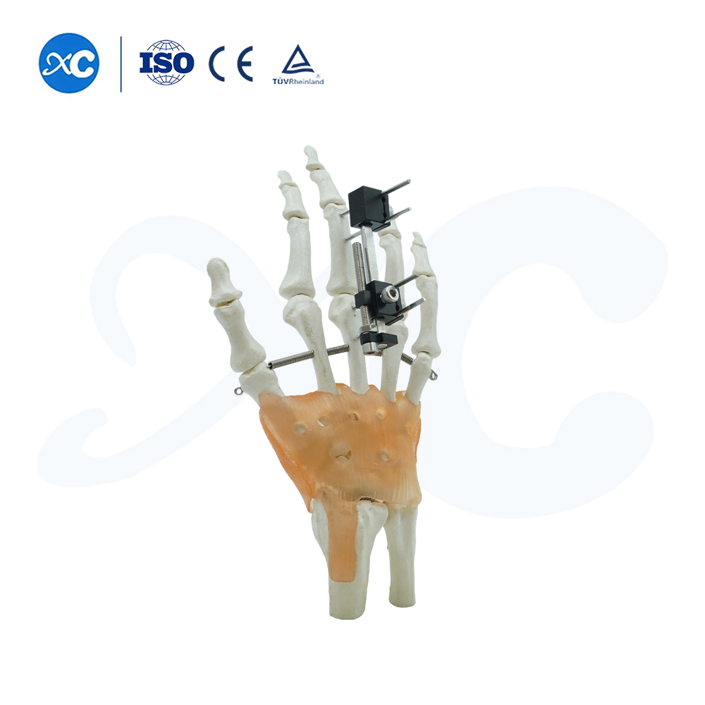 Mini Fixator Universal Compression Extension Type