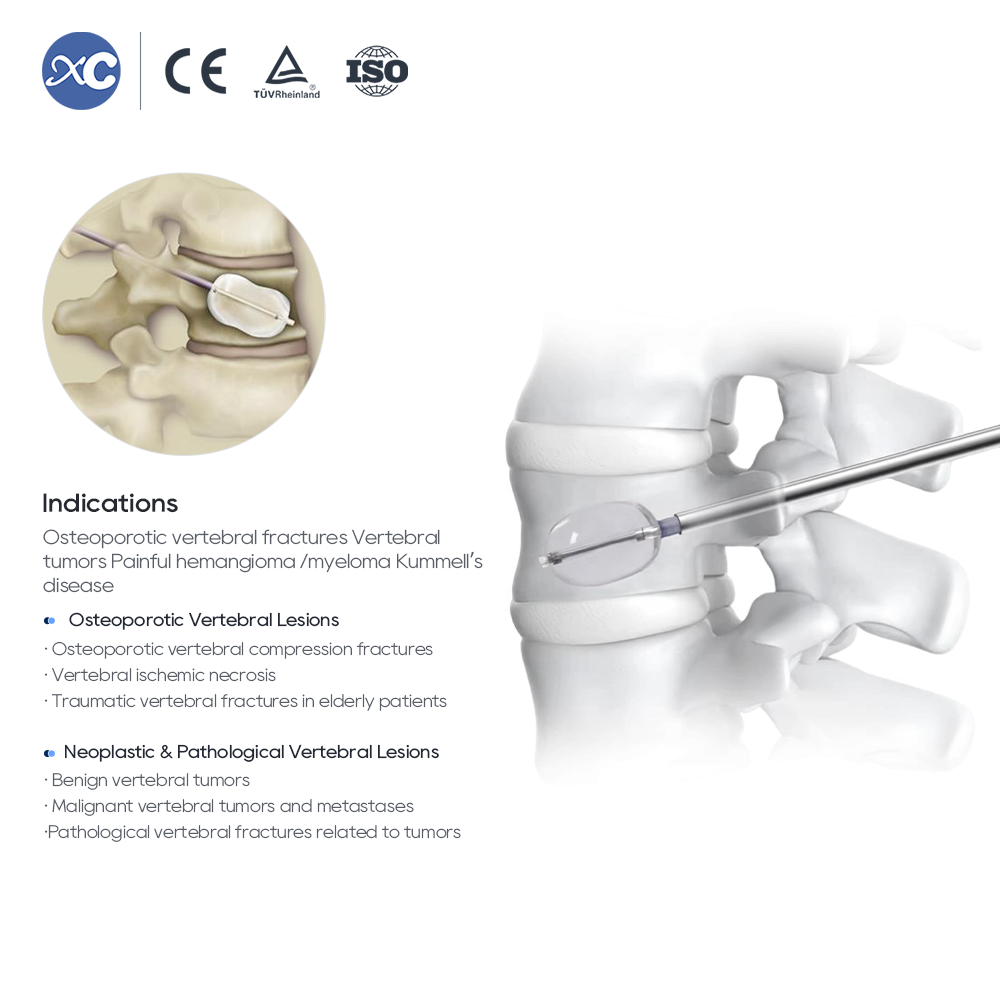 Kyphoplasty System (PKP) | Vertebral Balloon & Cement Kit