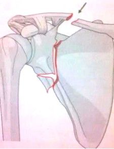Dijanjosi u Trattament ta 'Frattura ta' Clavicle-16