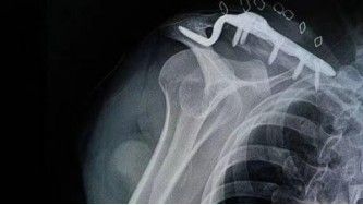 Dijanjosi u Trattament ta 'Frattura ta' Clavicle-27