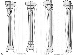 បច្ចេកទេសជួសជុលក្រចក Tibial Tibial intripullary-9