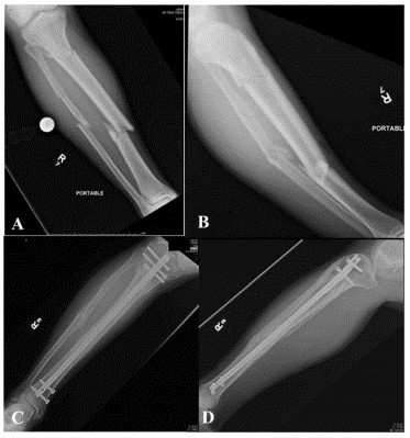 បច្ចេកទេសជួសជុលក្រចក Tibial Tibial Tienmaturary-12