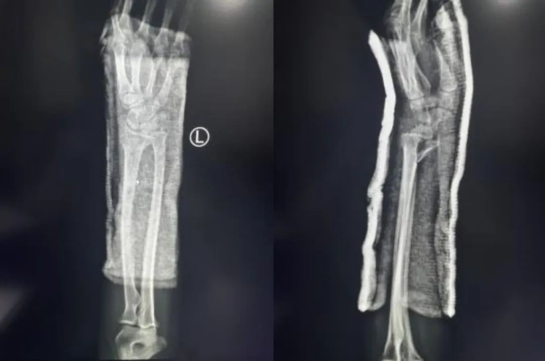 Distal Radius Fractures-17