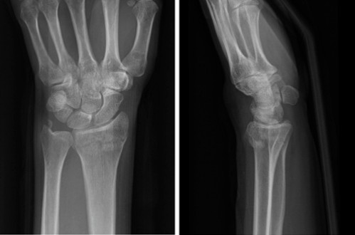Distal Radius Fractures-12