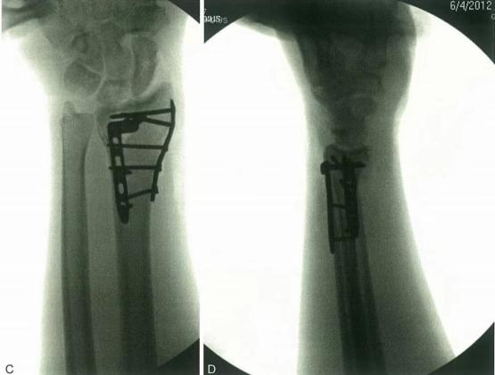 Distal Radius Fractures-23
