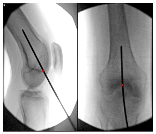 Femoral Intramedullary Nailing - How To Choose The Best Insertion Point-5