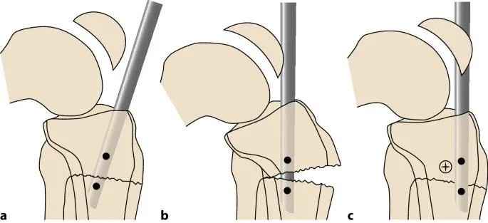 Tibial fractures, suprapatellar intramedullary nail technique